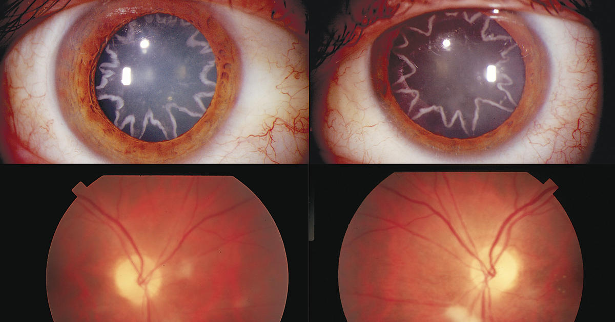Electric jolt causes star-shaped cataracts on man's eyes